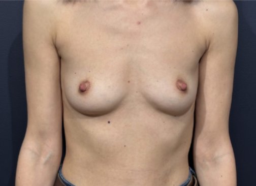 augmentation mammaire avant 1