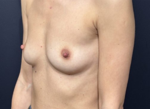 augmentation mammaire avant 2