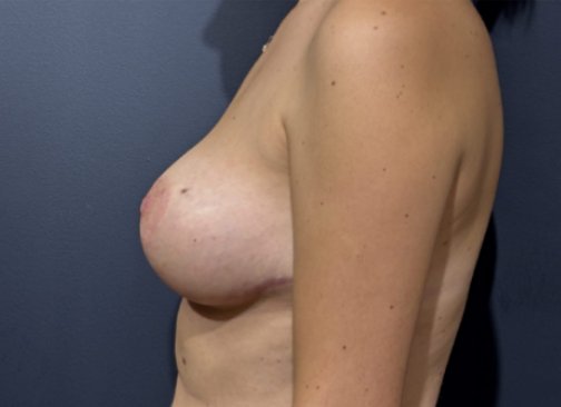 mastopexie après 1