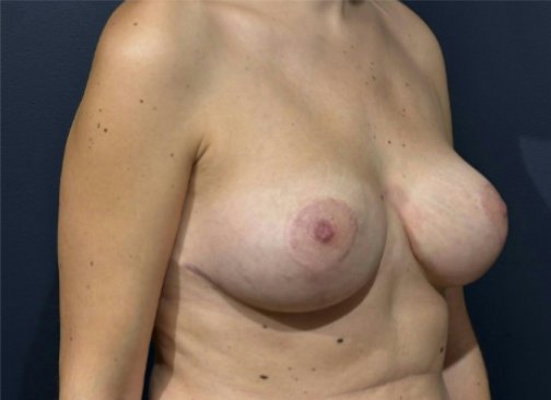 mastopexie après 2
