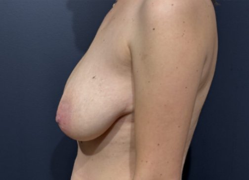 mastopexie avant 1