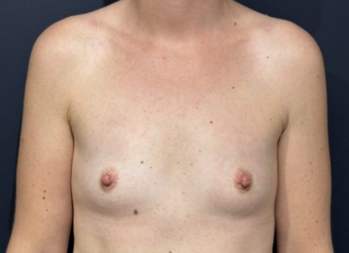 augmentation mammaire avant 7