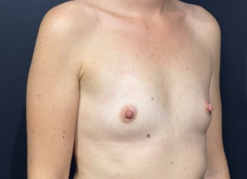 augmentation mammaire avant 8