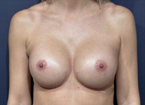 augmentation mammaire locale après 9