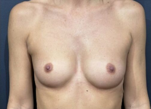 augmentation mammaire locale avant 9